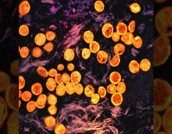 Mpox, not the new COVID, WHO reassures
