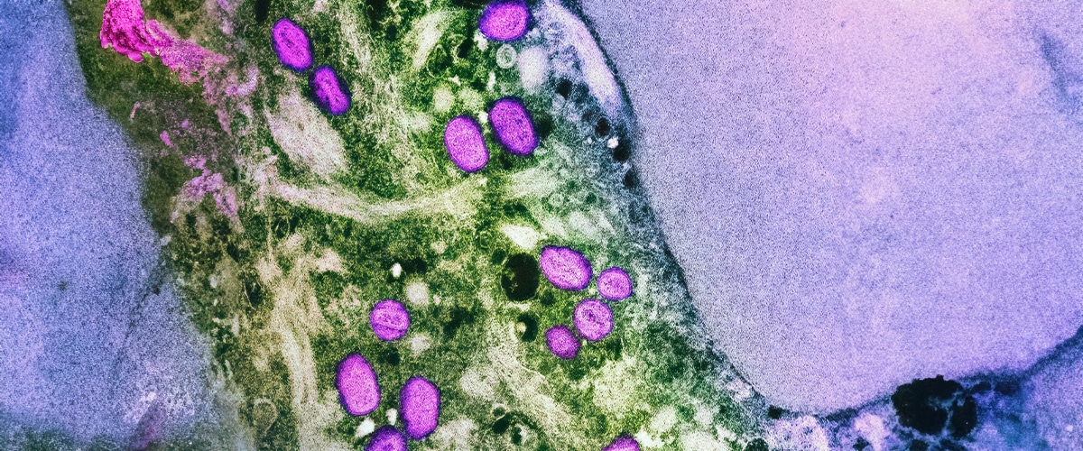 PH's 1st mpox case this year, traced back to spa, derma clinic in QC