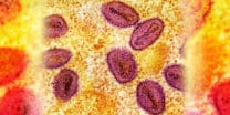 What you need to know about monkeypox